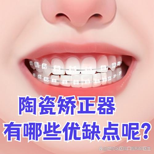 陶瓷正畸一般多少钱-图2 陶瓷正畸一般多少钱-图2