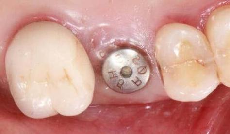 种牙植体iti-图2