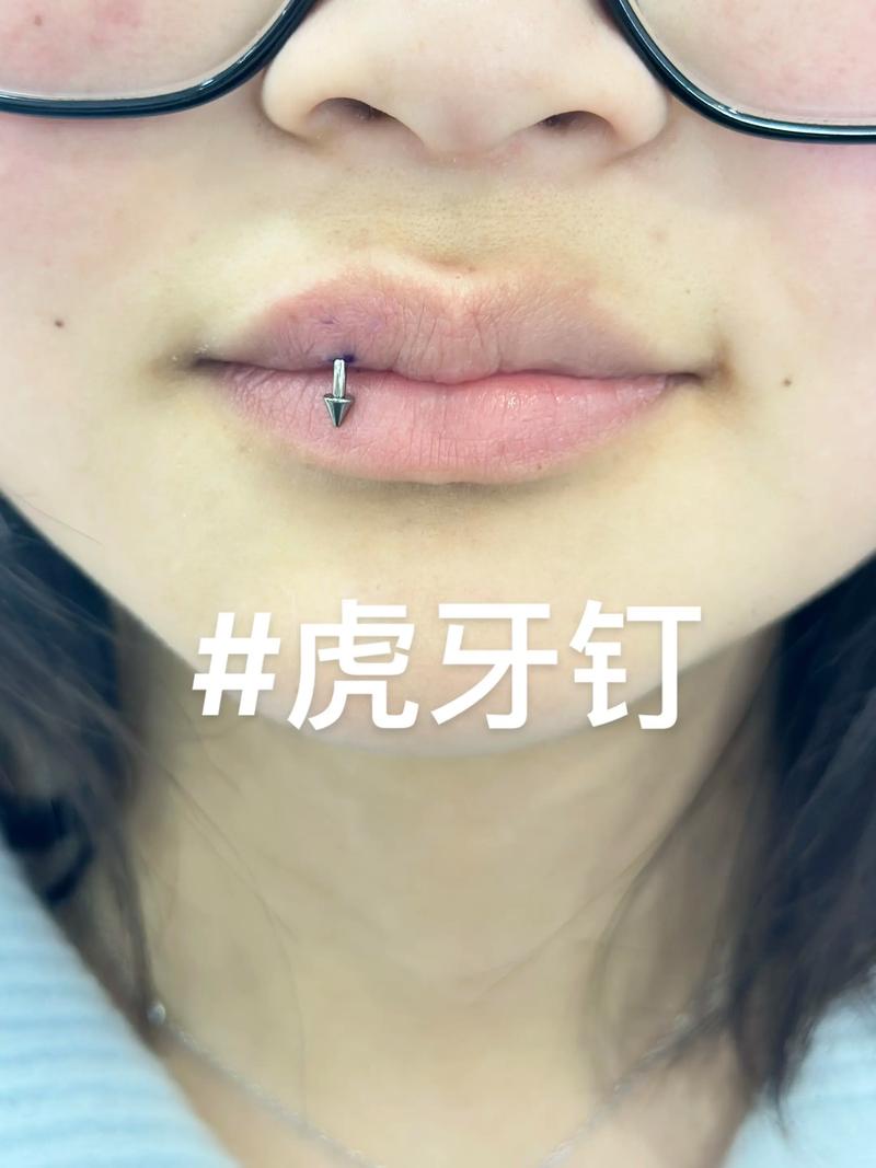 种牙金属钉尺寸如何选？影响种植效果的关键因素？-图3