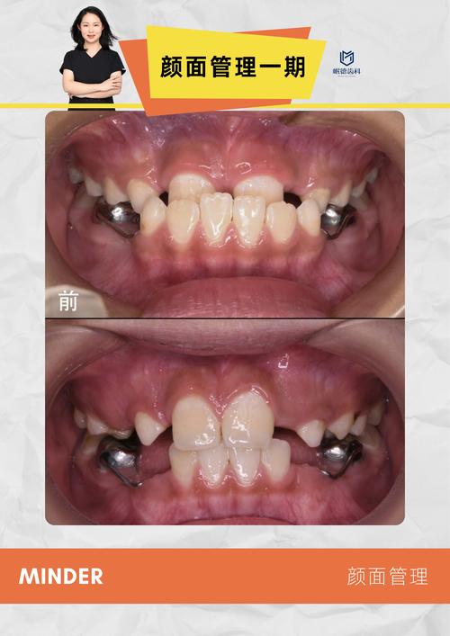 正畸钳变盾了怎么办-图3 正畸钳变盾了怎么办-图3