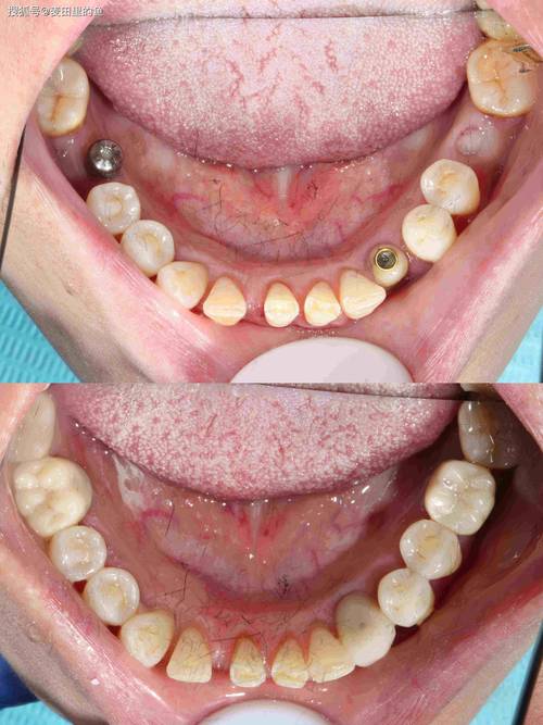 磨牙种牙过程是怎样的？需要拔牙吗？-图2