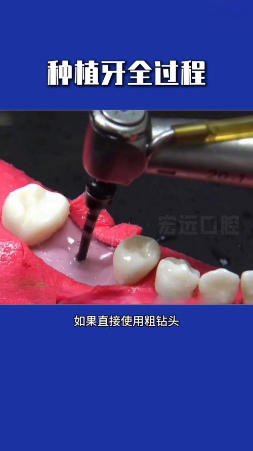 磨牙种牙过程是怎样的？需要拔牙吗？-图3