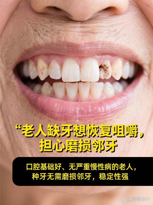 老人镶牙与种牙-图1