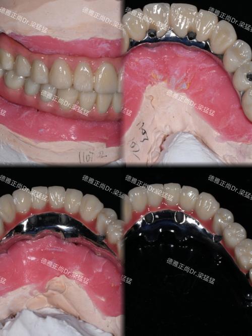 镶牙后为何需重新种牙？是镶牙失败还是另有原因？-图2