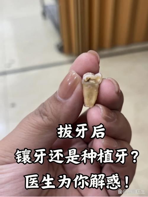 镶牙后为何需重新种牙？是镶牙失败还是另有原因？-图3