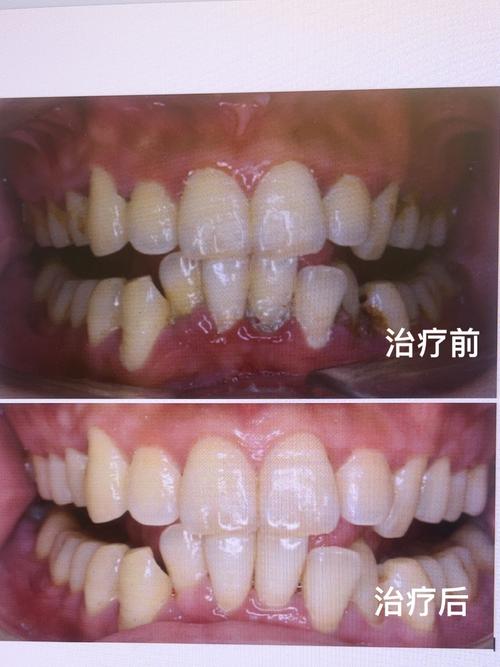 种牙后的牙周病-图3