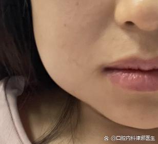 种牙后脸部肿胀-图1