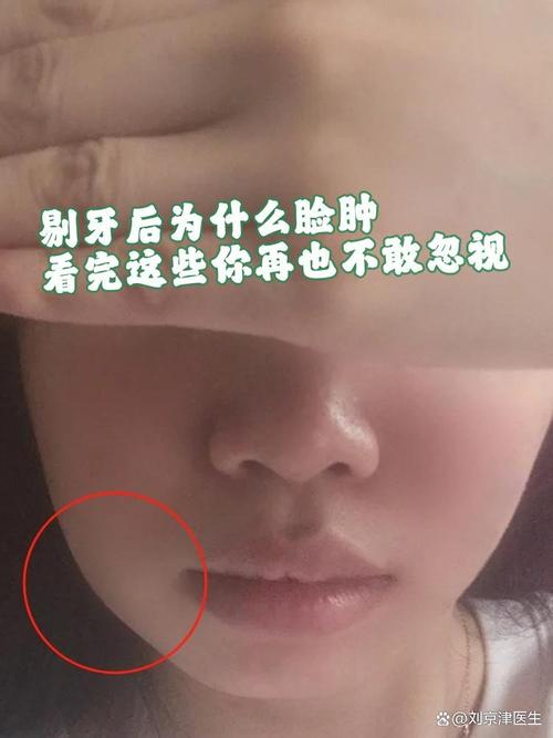 种牙后脸部肿胀-图3