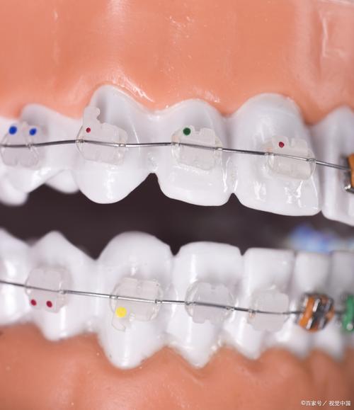 正畸控根辅弓王八曲-图3