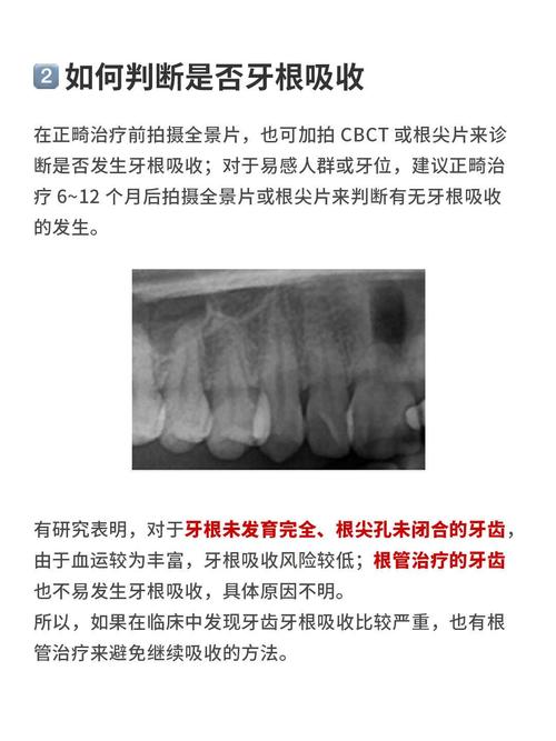 种牙自体骨吸收-图3
