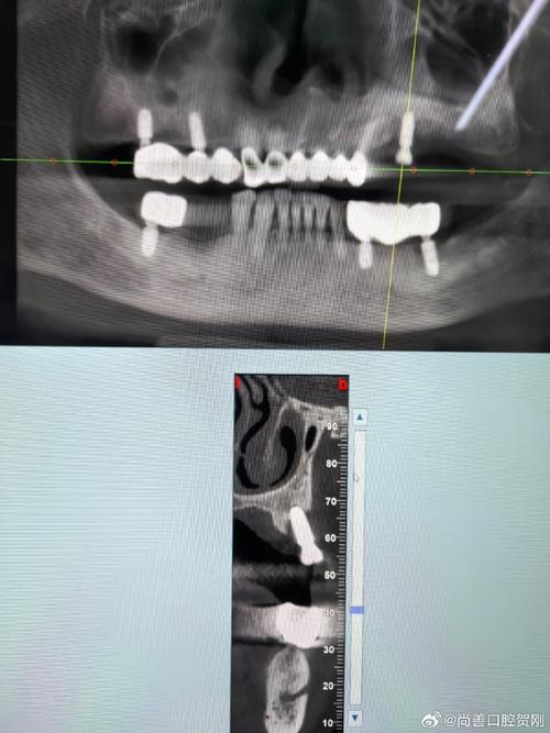 牙齿都没了种牙-图2 牙齿都没了种牙-图2