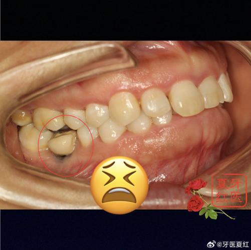 牙齿都没了种牙-图3 牙齿都没了种牙-图3