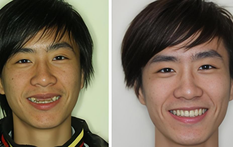 20多岁就种牙，年轻人牙齿提前下岗的原因何在？-图2