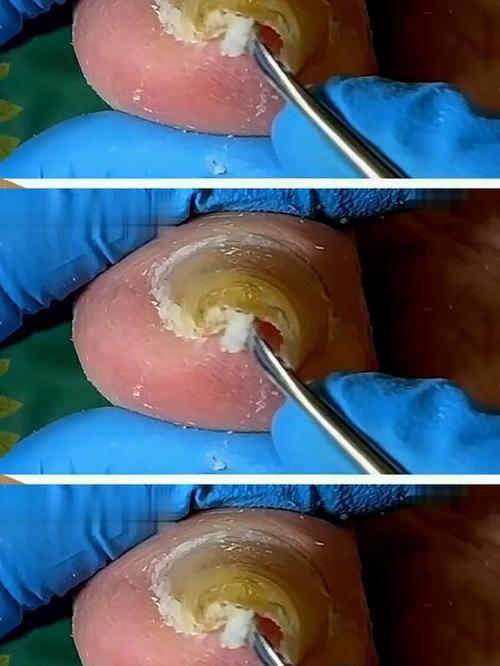 种牙钢钉掉出来-图3 种牙钢钉掉出来-图3