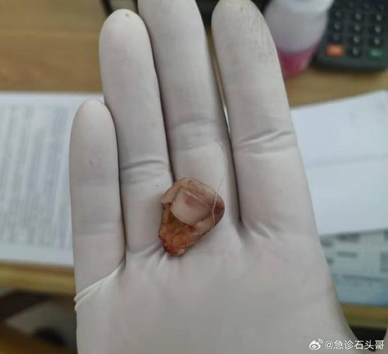 种牙钢钉掉出来-图2 种牙钢钉掉出来-图2