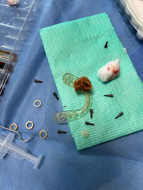 种牙钢钉掉出来-图1 种牙钢钉掉出来-图1