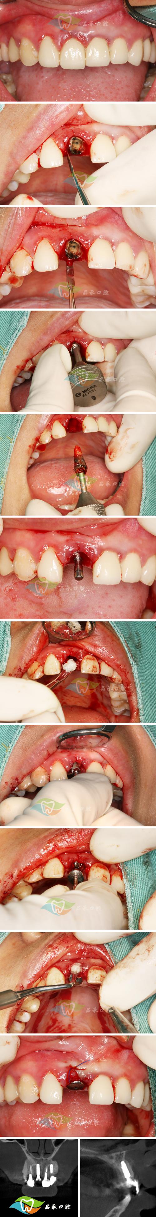 吉大口腔 种牙-图3