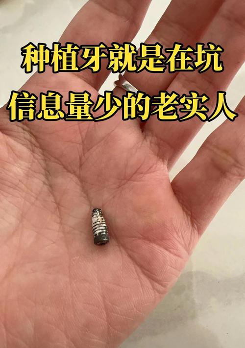 种牙钛合金危害-图1