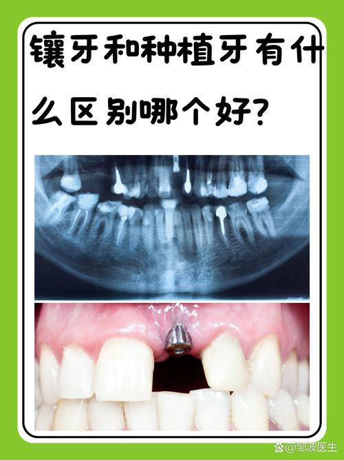 种牙钛合金危害-图2