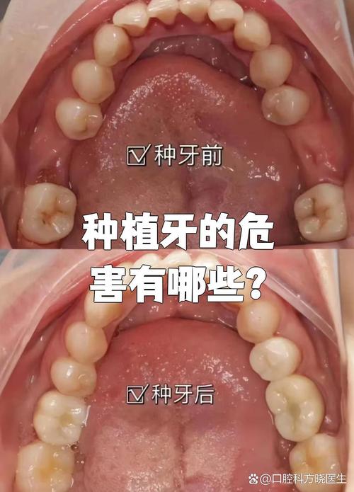种牙钛合金危害-图3
