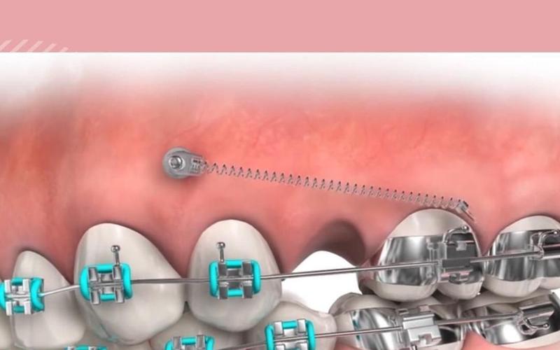 正畸打骨钉会脱落吗-图1