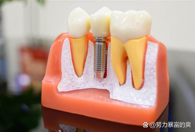 种牙后牙冠高度-图2