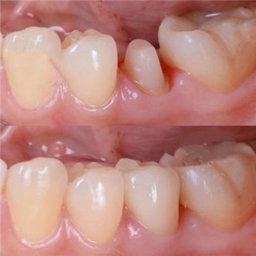 种牙后牙冠高度-图1