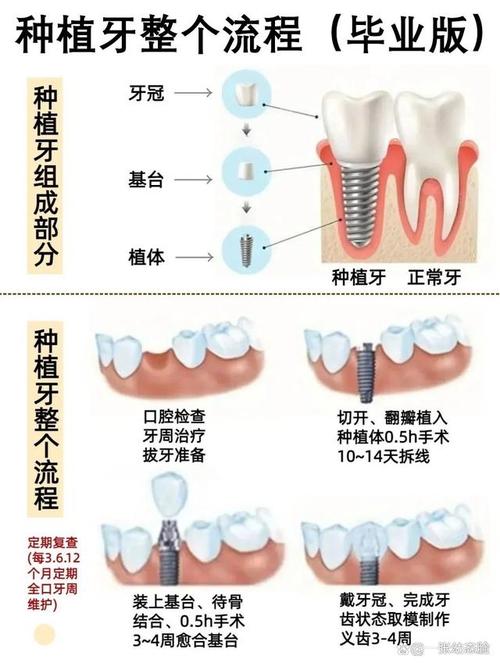 怎样去韩国种牙-图3 怎样去韩国种牙-图3