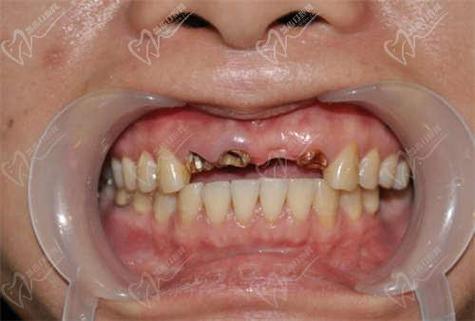 海宁李森 种牙-图3