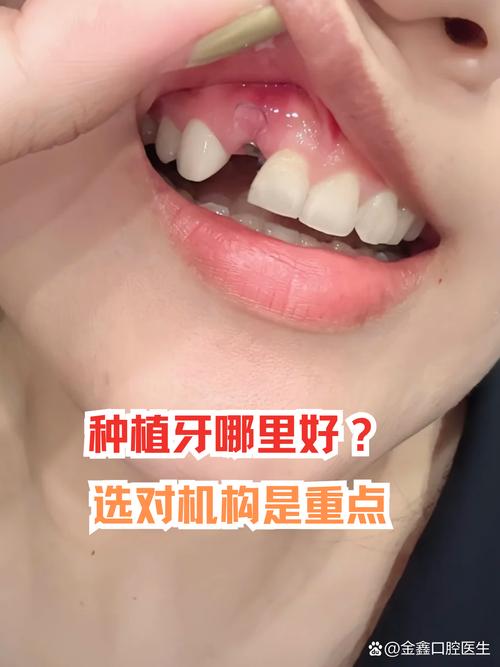 海宁李森 种牙-图1