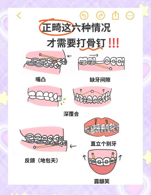 两个六缺失，正畸矫正该如何进行？有解决方法吗？-图2