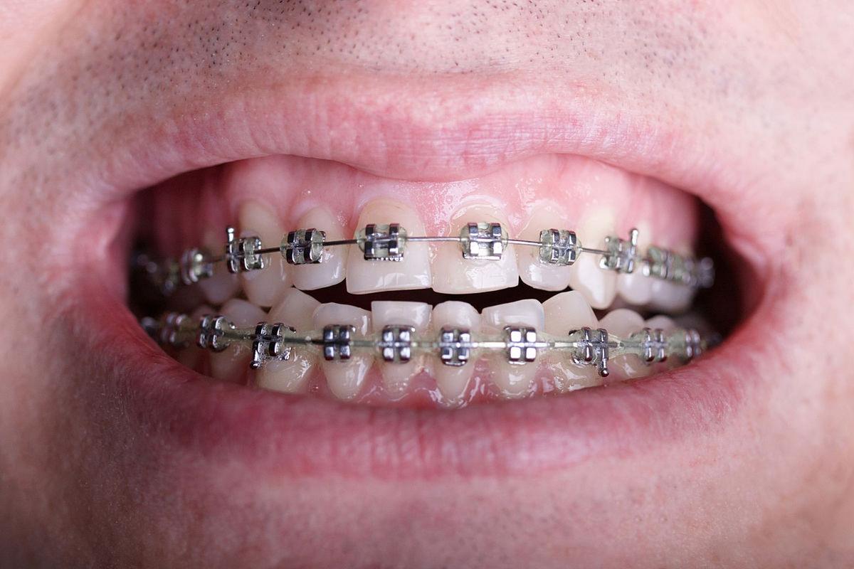 正畸铁丝移动到一边-图1