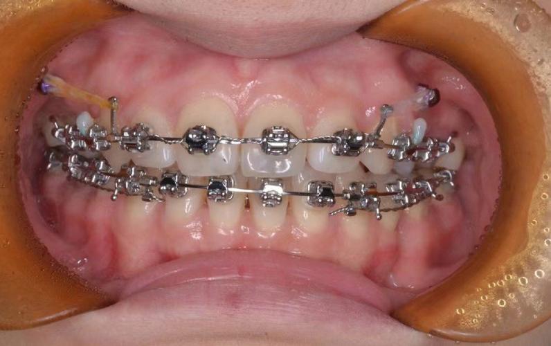 正畸铁丝移动到一边-图2