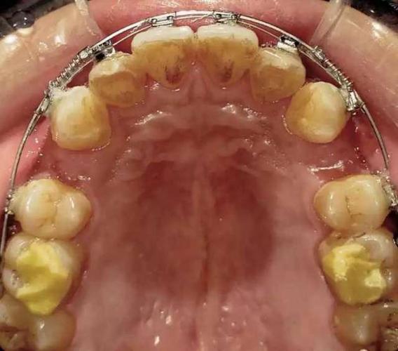 梅志强正畸视频密码是什么？正畸关键技巧大揭秘！-图2