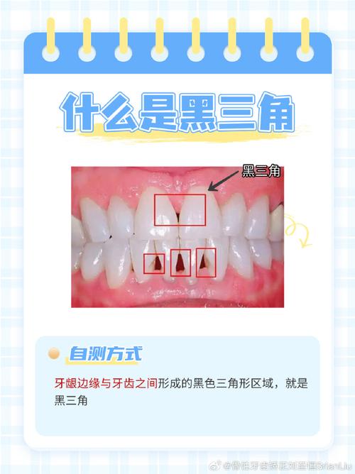 正畸如何关闭黑三角-图3