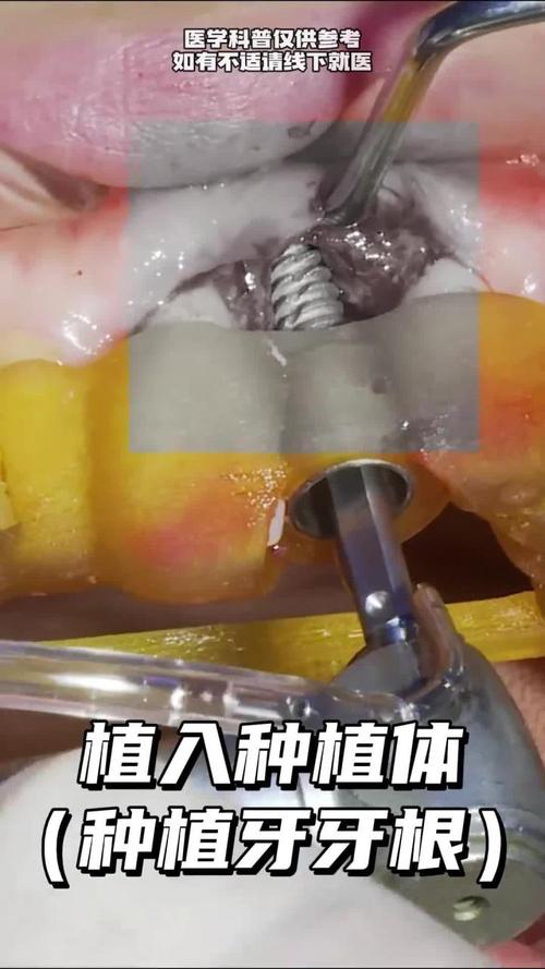 种植牙牙根松动是什么原因导致的？-图1