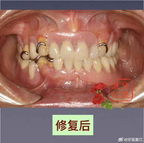 镶牙之后，为何需要换种牙？-图3