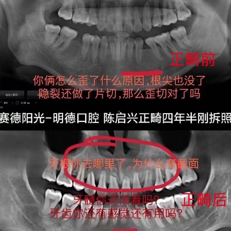 正畸托槽粘歪导致牙齿歪斜，是什么原因造成的？怎么解决？-图3