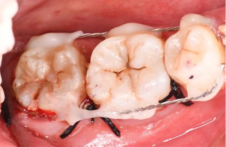 自体骨植入种牙-图1