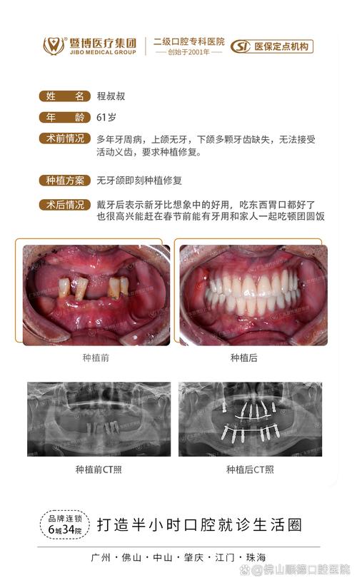 种牙成功的案例-图2