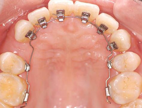正畸舌挡是活动的吗-图1 正畸舌挡是活动的吗-图1