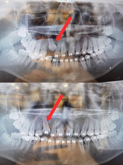 正畸随形弓图如何有效压低牙齿?-图3 正畸随形弓图如何有效压低牙齿?-图3