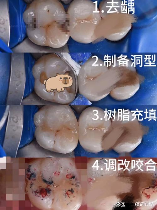 广州补牙和种牙有何不同？哪种更适合你？-图1