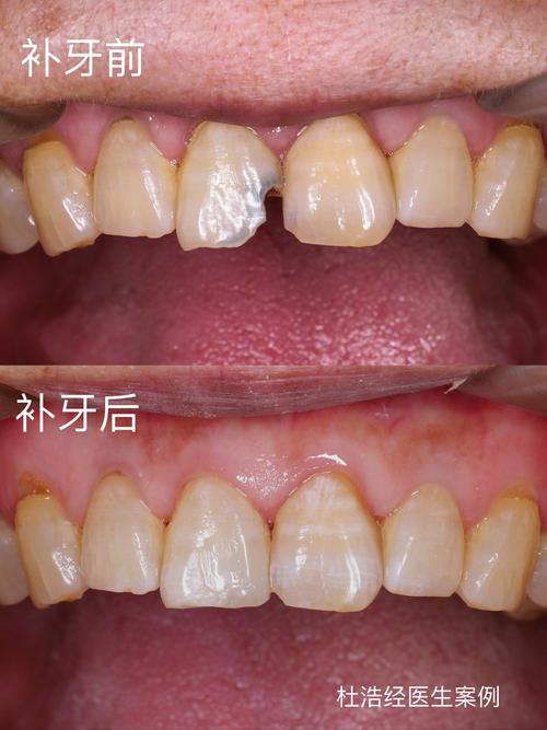 广州补牙和种牙有何不同？哪种更适合你？-图3
