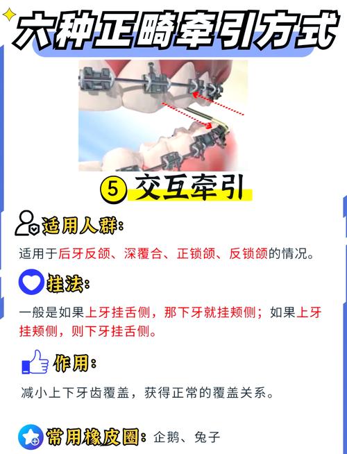 正畸牵引钩怎么弯制-图2 正畸牵引钩怎么弯制-图2