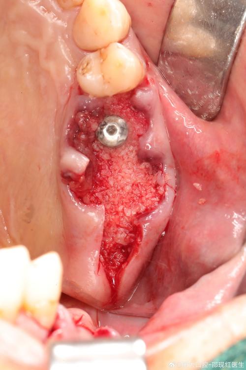 种牙手术后准备-图3
