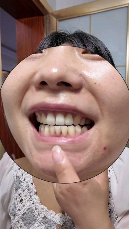 正畸后种牙周期多长?有哪些关键影响因素?-图1 正畸后种牙周期多长?有哪些关键影响因素?-图1