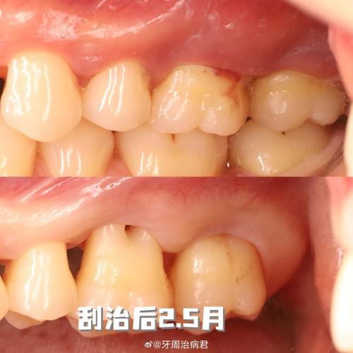 正畸后种牙周期多长?有哪些关键影响因素?-图2 正畸后种牙周期多长?有哪些关键影响因素?-图2