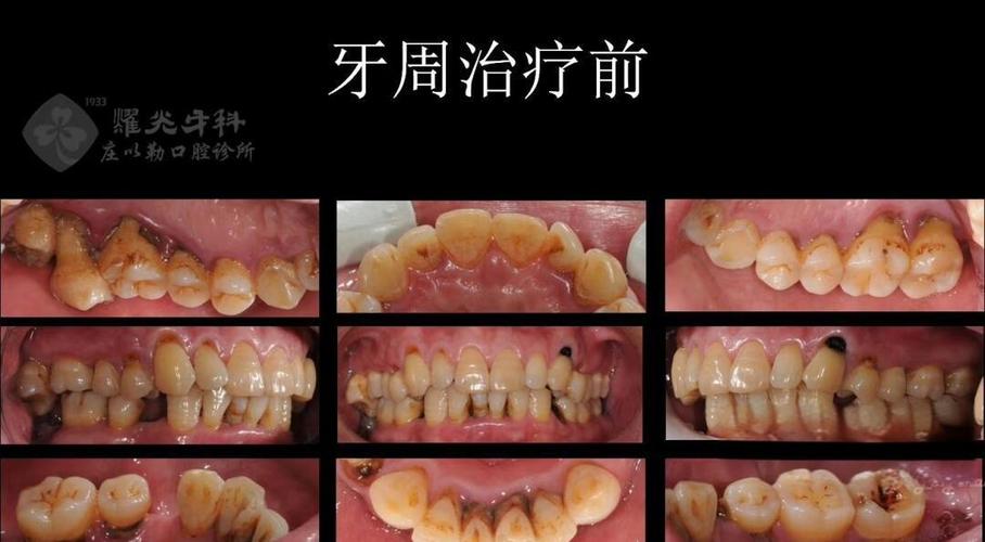 正畸后种牙周期多长?有哪些关键影响因素?-图3 正畸后种牙周期多长?有哪些关键影响因素?-图3