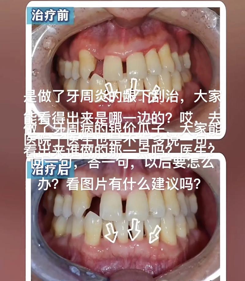 龈下刮治后多久能开始正畸？-图1